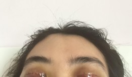 双眼皮手术对财运的影响，迷信与现实的碰撞