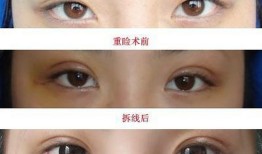 双眼皮手术后的潜在后遗症及其预防措施