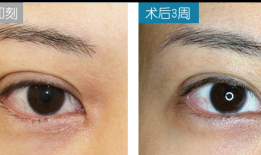 双眼皮手术后的潜在后遗症及其应对策略