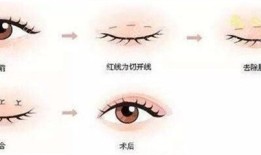 双眼皮手术对身体的影响及其注意事项