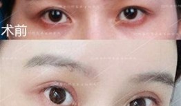 双眼皮手术后的潜在后遗症及其应对策略