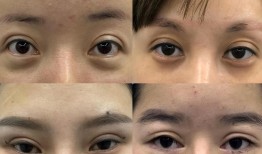 双眼皮手术，对眼睛影响的深度解析