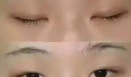 双眼皮手术后的潜在后遗症及其预防措施