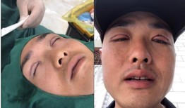 双眼皮手术，影响与注意事项