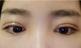 双眼皮手术，美丽背后的潜在后遗症