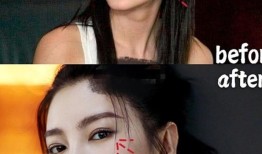 双眼皮手术后的长期影响及其对日常生活的影响