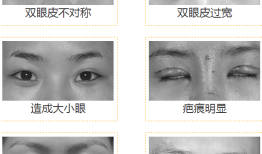 双眼皮手术，效果、风险与后遗症全面解析