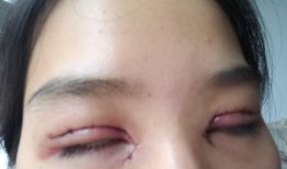 双眼皮手术恢复过程全记录，从术后第一天到完全康复