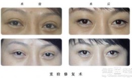 双眼皮手术，效果、风险与后遗症全面解析