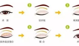 双眼皮手术，效果、风险与术后护理全解析