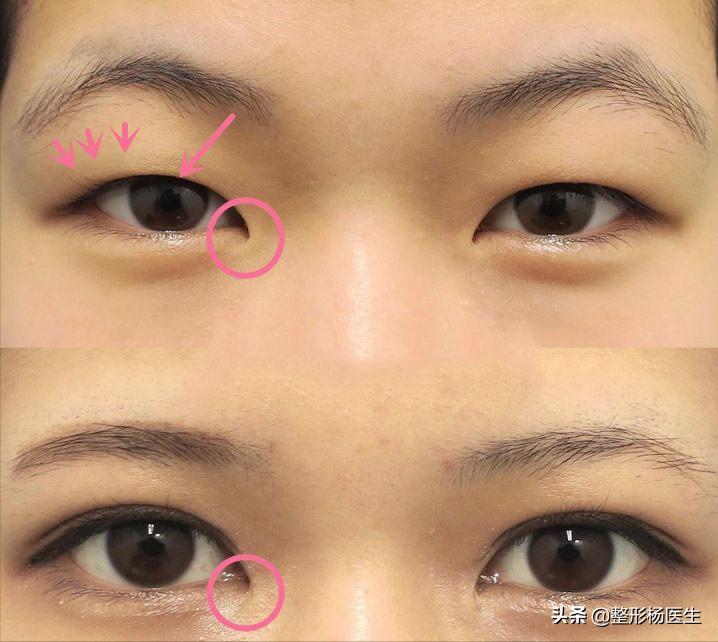 双眼皮手术后的后遗症及其预防措施